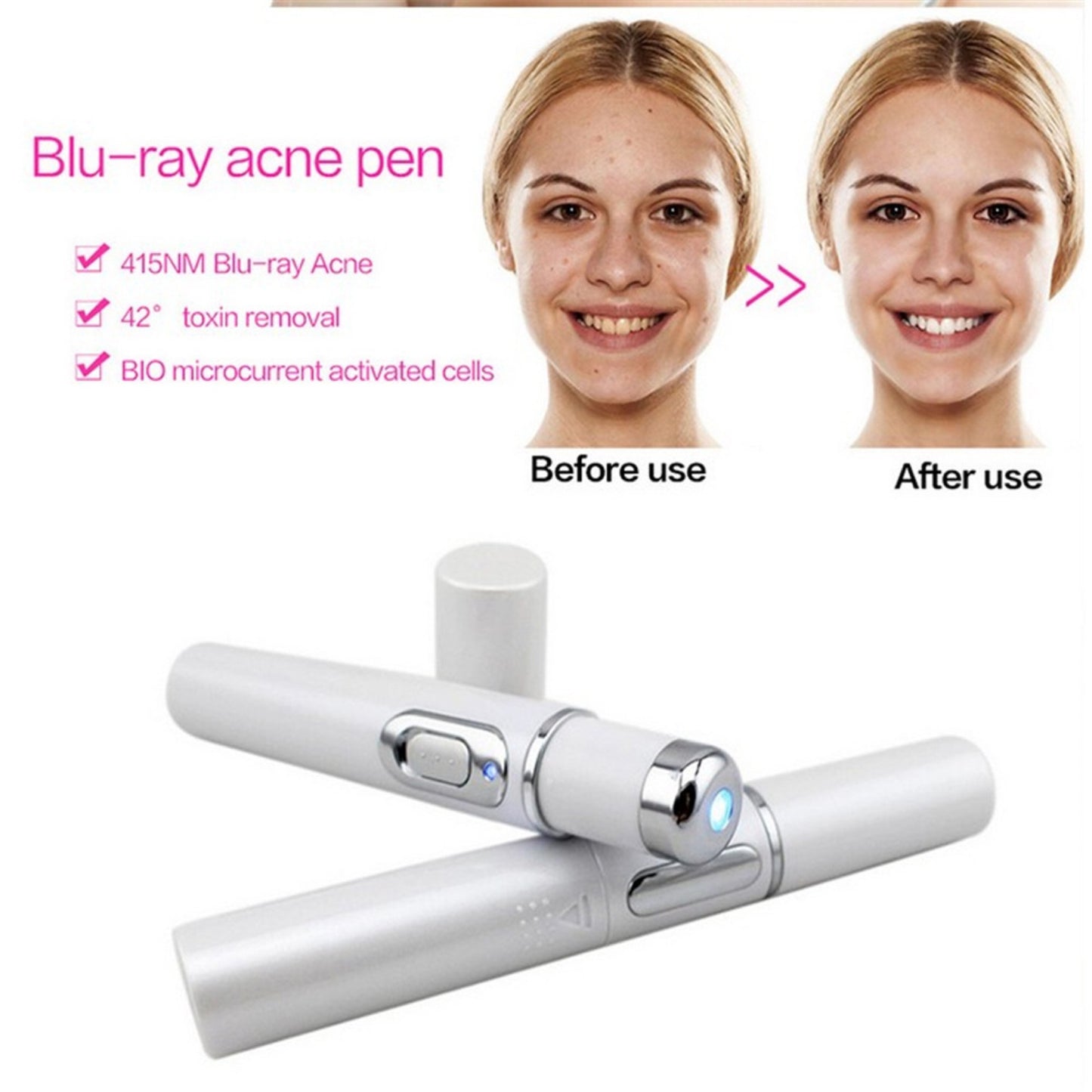 Acne Laser Blue Light Therapy P