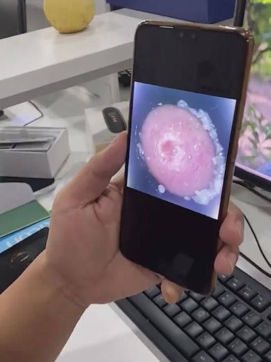 Wireless Blackhead Visualization Device for Deep Pore Extraction